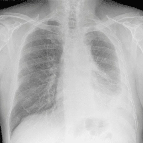 Asbestos Exposure